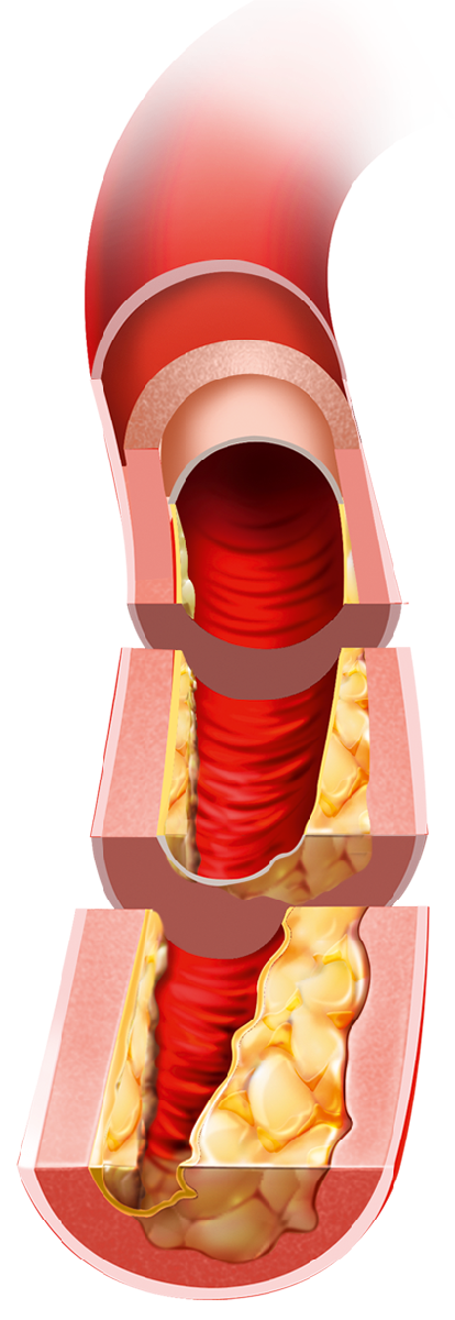 Blood vessels with atherosclerosis